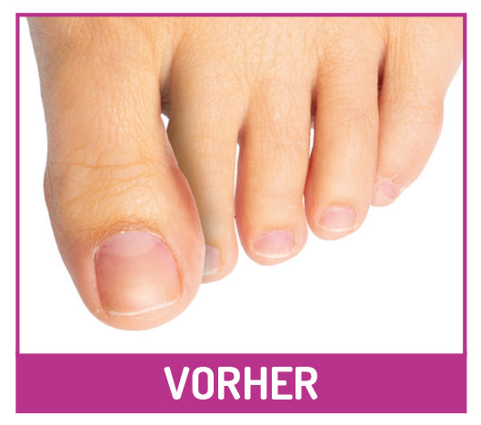 1 Paar Zehen-Distanz-Schiene Zehenspreizer Zehenfehlstellung Hammerzehen Hallux